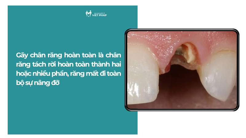 Gãy chân răng hoàn toàn là chân răng tách rời hoàn toàn thành hai hoặc nhiều phần, răng mất đi toàn bộ sự nâng đỡ