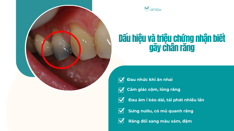 Dấu hiệu và triệu chứng nhận biết gãy chân răng 