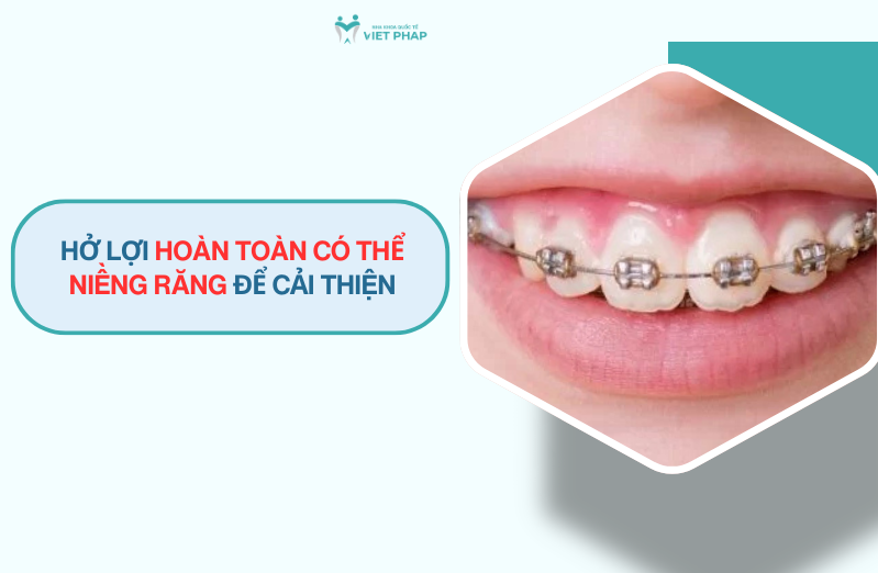 ho loi co nieng rang duoc khong 2 Hở lợi hoàn toàn CÓ THỂ NIỀNG RĂNG để cải thiện