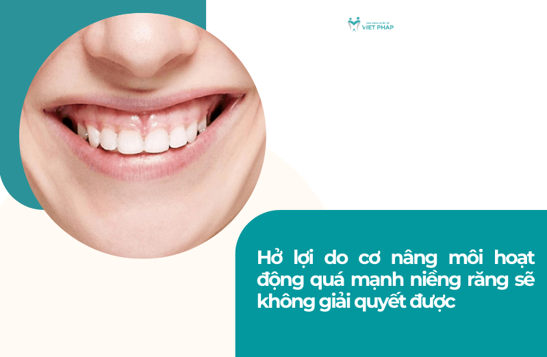 ho loi co nieng rang duoc khong 4 Hở lợi do cơ nâng môi hoạt động quá mạnh niềng răng sẽ không giải quyết được
