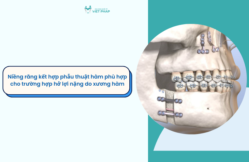ho loi co nieng rang duoc khong 6 Niềng răng kết hợp phẫu thuật hàm phù hợp cho trường hợp hở lợi nặng do xương hàm
