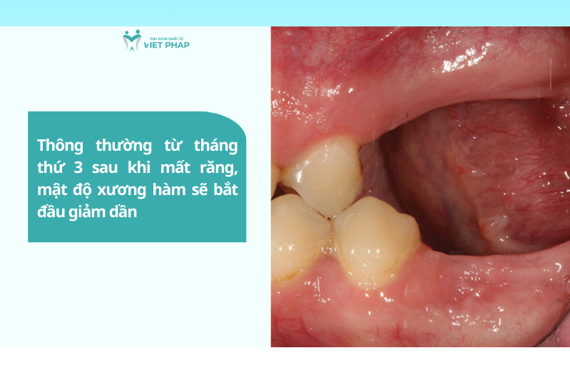 mat rang bao lau thi bi tieu xuong ham 1 Thông thường từ tháng thứ 3 sau khi mất răng, mật độ xương hàm sẽ bắt đầu giảm dần
