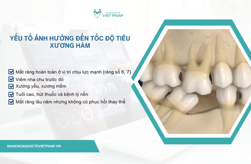 mat rang bao lau thi bi tieu xuong ham 2 Các yếu tố ảnh hưởng đến tốc độ tiêu xương hàm
