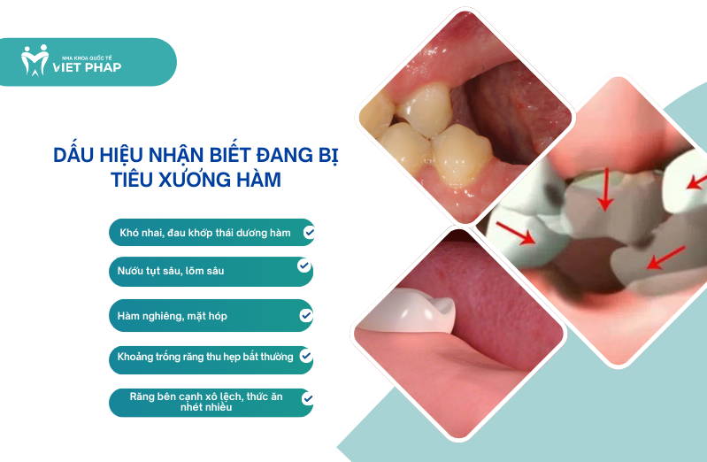 mat rang bao lau thi bi tieu xuong ham 3 Dấu hiệu nhận biết đang bị tiêu xương hàm