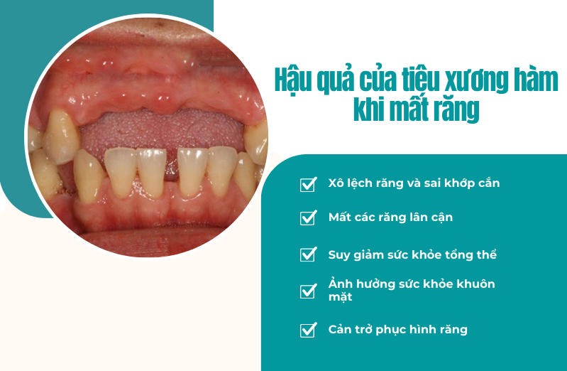 mat rang bao lau thi bi tieu xuong ham 5 Hậu quả của tiêu xương hàm khi mất răng