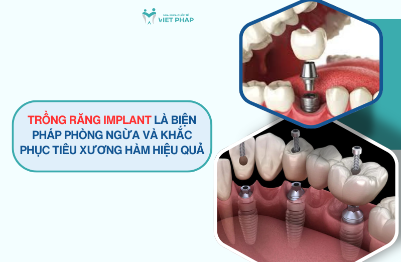 mat rang bao lau thi bi tieu xuong ham 6 Trồng răng implant là biện pháp phòng ngừa và khắc phục tiêu xương hàm hiệu quả