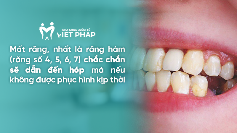 Mất răng, nhất là răng hàm (răng số 4, 5, 6, 7) chắc chắn sẽ dẫn đến hóp má nếu không được phục hình kịp thời