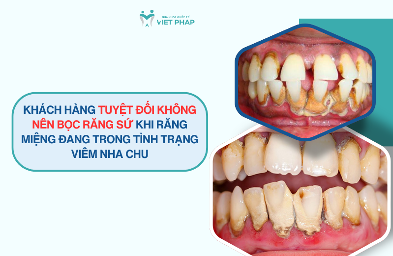 Khách hàng tuyệt đối KHÔNG NÊN bọc răng sứ khi răng miệng đang trong tình trạng viêm nha chu