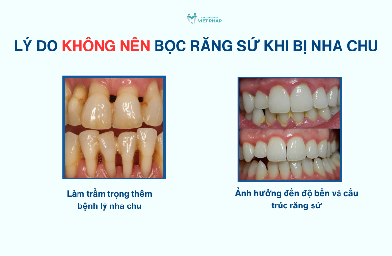 2 lý do KHÔNG NÊN bọc răng sứ khi bị nha chu