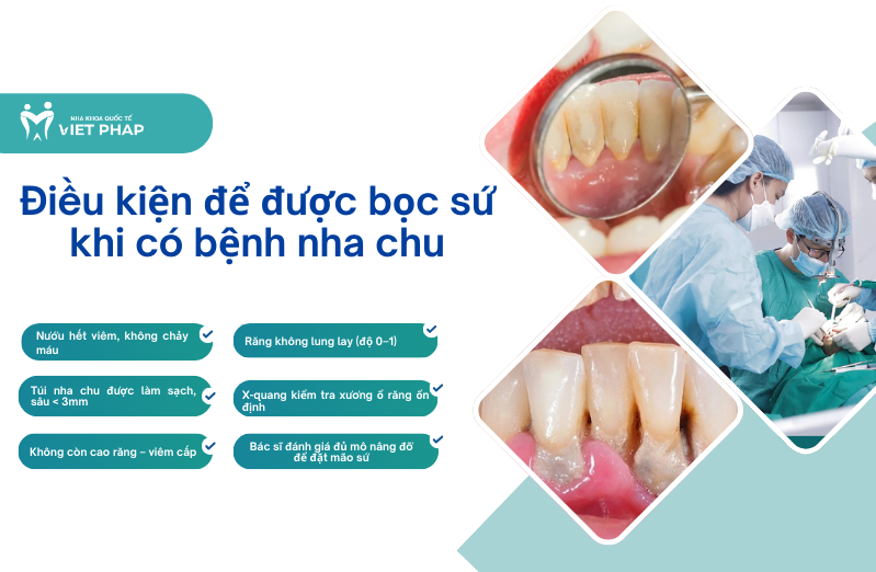 Điều kiện để được bọc sứ khi có bệnh nha chu
