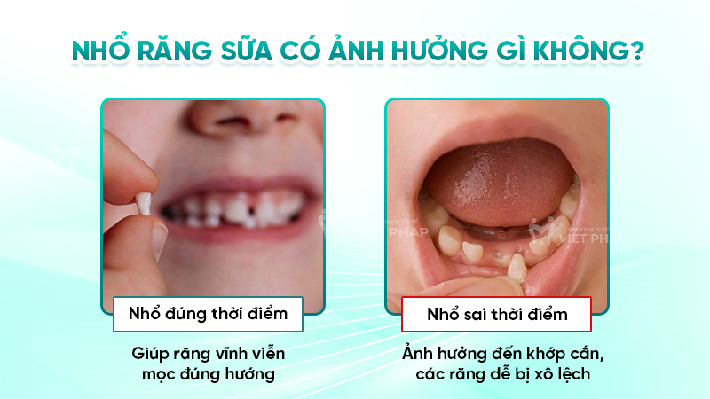 Nhổ răng sữa có ảnh hưởng gì không?