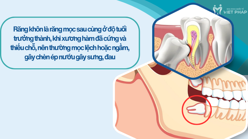 Răng khôn là răng mọc sau cùng ở độ tuổi trưởng thành, khi xương hàm đã cứng và thiếu chỗ, nên thường mọc lệch hoặc ngầm, gây chèn ép nướu gây sưng, đau