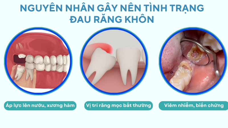 Nguyên nhân gây nên tình trạng đau răng khôn