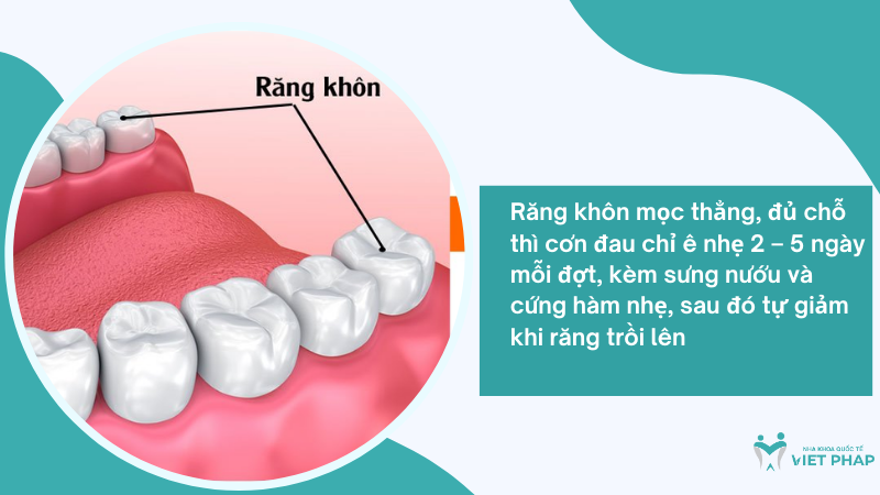 Răng khôn mọc thẳng, đủ chỗ thì cơn đau chỉ ê nhẹ 2 – 5 ngày mỗi đợt, kèm sưng nướu và cứng hàm nhẹ, sau đó tự giảm khi răng trồi lên