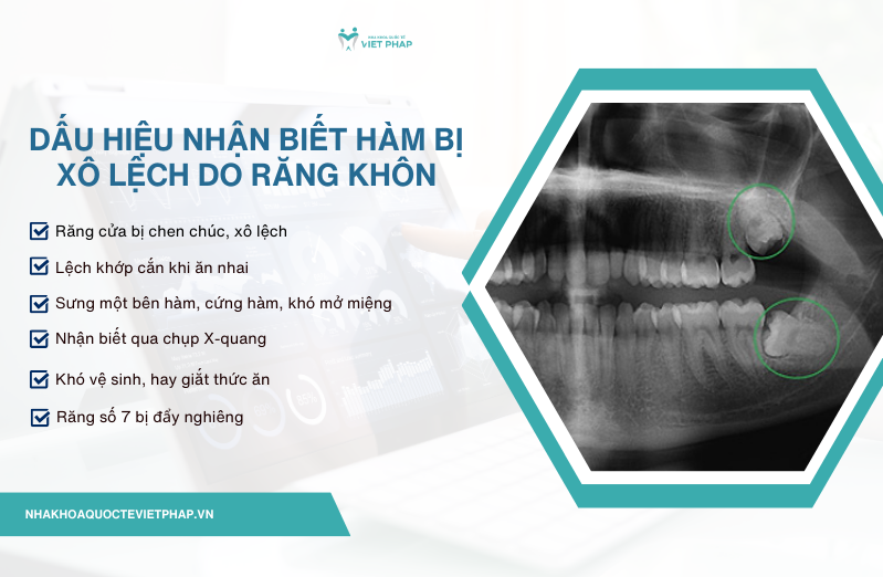 Dấu hiệu nhận biết hàm bị xô lệch do răng khôn