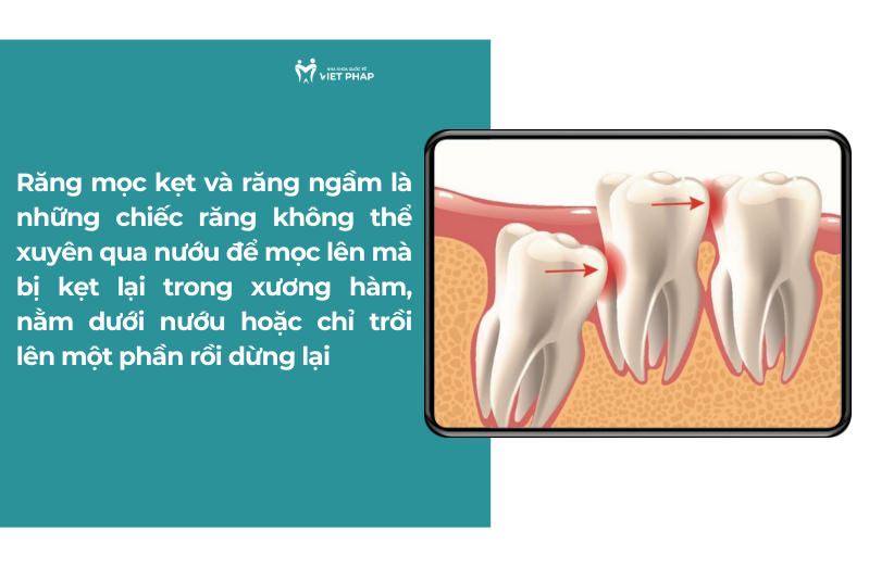 Răng mọc kẹt và răng ngầm là những chiếc răng không thể xuyên qua nướu để mọc lên mà bị kẹt lại trong xương hàm, nằm dưới nướu hoặc chỉ trồi lên một phần rồi dừng lại