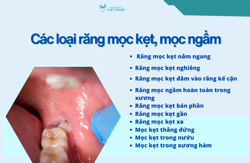 Các loại răng mọc kẹt, mọc ngầm thường gặp