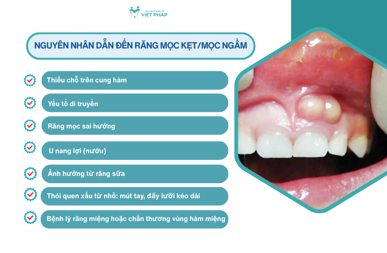 Nguyên nhân dẫn đến răng mọc kẹt/mọc ngầm