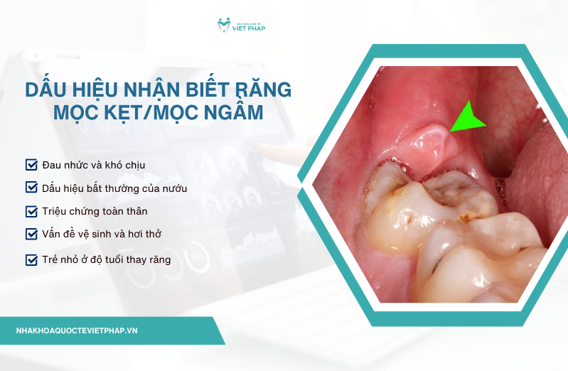 Dấu hiệu nhận biết răng mọc kẹt/mọc ngầm