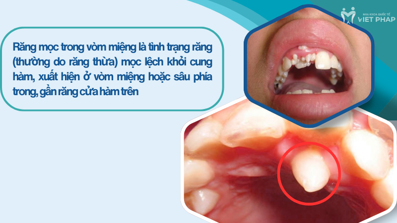 rang moc trong vom mieng 1 Răng mọc trong vòm miệng là tình trạng răng (thường do răng thừa) mọc lệch khỏi cung hàm, xuất hiện ở vòm miệng hoặc sâu phía trong, gần răng cửa hàm trên