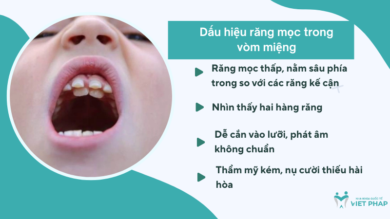 rang moc trong vom mieng 2 Dấu hiệu răng mọc trong vòm miệng