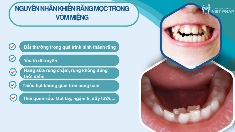 rang moc trong vom mieng 3 Nguyên nhân khiến răng mọc trong vòm miệng