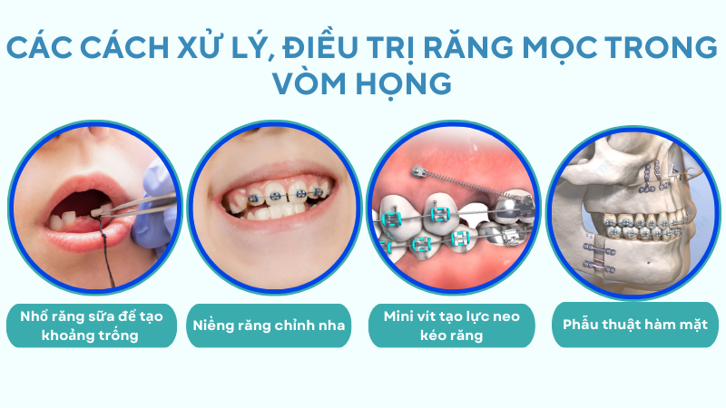 rang moc trong vom mieng 4 Các cách xử lý, điều trị răng mọc trong vòm họng