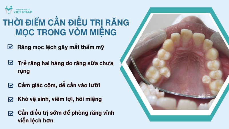 rang moc trong vom mieng 5 Thời điểm cần điều trị răng mọc trong vòm miệng