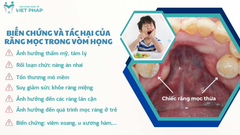 rang moc trong vom mieng 6 Biến chứng và tác hại của răng mọc trong vòm họng