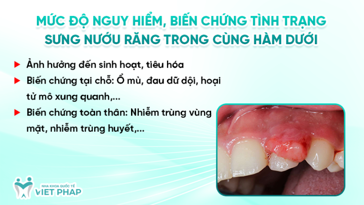 [Cảnh báo] Sưng nướu răng trong cùng hàm dưới nguy hiểm? Nguyên nhân và ...