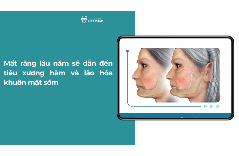tac hai cua viec mat rang lau nam 2 Mất răng lâu năm sẽ dẫn đến tiêu xương hàm và lão hóa khuôn mặt sớm