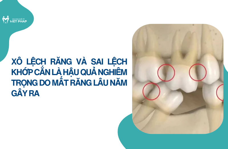 tac hai cua viec mat rang lau nam 3 Xô lệch răng và sai lệch khớp cắn là hậu quả nghiêm trọng do mất răng lâu năm gây ra