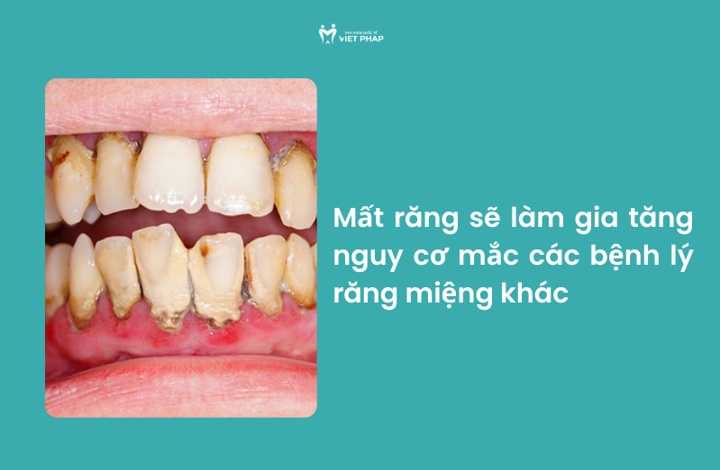tac hai cua viec mat rang lau nam 6 Mất răng sẽ làm gia tăng nguy cơ mắc các bệnh lý răng miệng khác