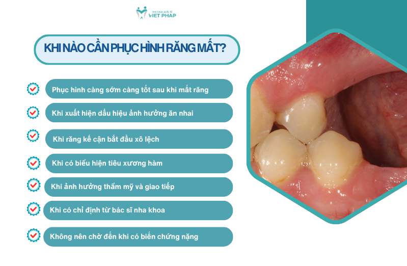 tac hai cua viec mat rang lau nam 7 Khi nào cần phục hình răng mất?