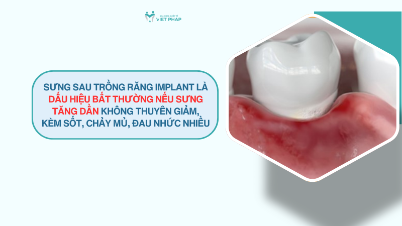 Sưng sau trồng răng implant là dấu hiệu bất thường nếu sưng tăng dần không thuyên giảm, kèm sốt, chảy mủ, đau nhức nhiều