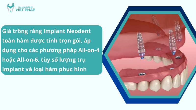 Implant neodent gia bao nhieu nha khoa quoc teviet phap 3 Giá trồng răng Implant Neodent toàn hàm được tính trọn gói, áp dụng cho các phương pháp All-on-4 hoặc All-on-6, tùy số lượng trụ Implant và loại hàm phục hình
