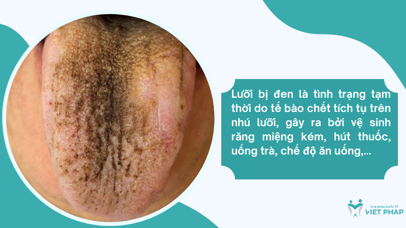 luoi bi den Lưỡi bị đen là tình trạng tạm thời do tế bào chết tích tụ trên nhú lưỡi, gây ra bởi vệ sinh răng miệng kém, hút thuốc, uống trà, chế độ ăn uống,...
