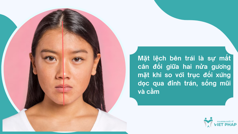 mat lech ben trai 2 Mặt lệch bên trái là sự mất cân đối giữa hai nửa gương mặt khi so với trục đối xứng dọc qua đỉnh trán, sống mũi và cằm