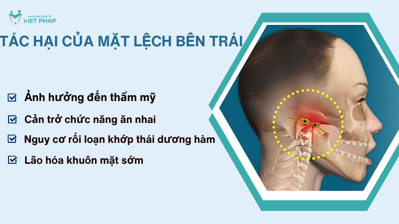 mat lech ben trai 4 Tác hại của mặt lệch bên trái