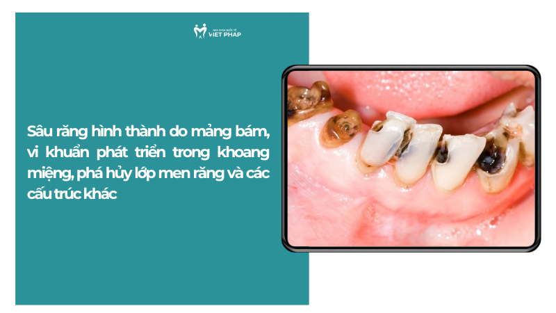 nguyen nhan gay sau rang 1 Sâu răng hình thành do mảng bám, vi khuẩn phát triển trong khoang miệng, phá hủy lớp men răng và các cấu trúc khác