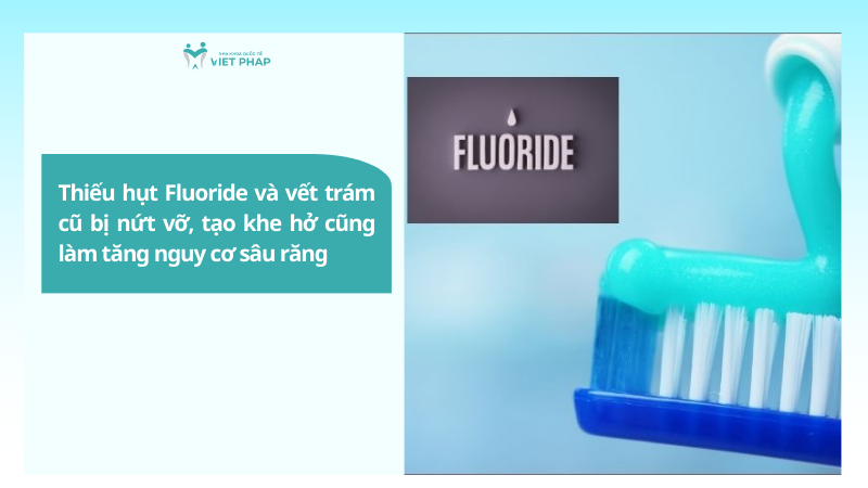 nguyen nhan gay sau rang 3 Thiếu hụt Fluoride và vết trám cũ bị nứt vỡ, tạo khe hở cũng làm tăng nguy cơ sâu răng