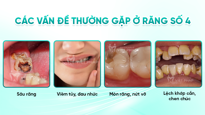 rang so 4 5 Các vấn đề thường gặp ở răng số 4