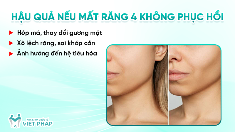 rang so 4 7 Hậu quả nếu mất răng 4 không phục hồi
