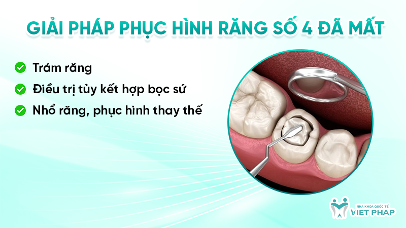 rang so 4 8 Giải pháp phục hình răng số 4 đã mất