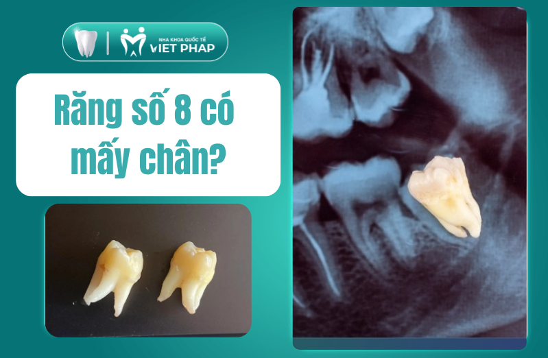 Răng số 8 có mấy chân? Từ 1 đến 3 chân, cảnh báo nguy hiểm