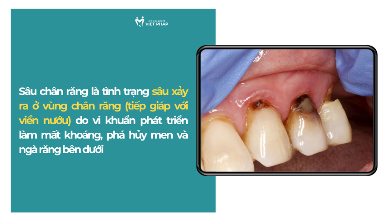 Sâu chân răng là tình trạng sâu xảy ra ở vùng chân răng (tiếp giáp với viền nướu) do vi khuẩn phát triển làm mất khoáng, phá hủy men và ngà răng bên dưới