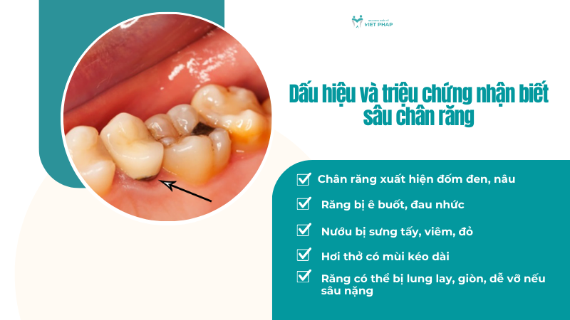 Dấu hiệu và triệu chứng nhận biết sâu chân răng