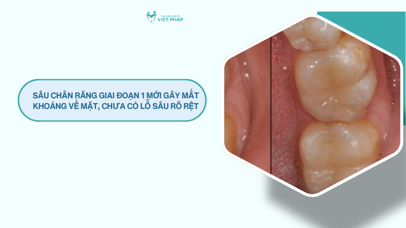 Sâu chân răng giai đoạn 1 mới gây mất khoáng về mặt, chưa có lỗ sâu rõ rệt