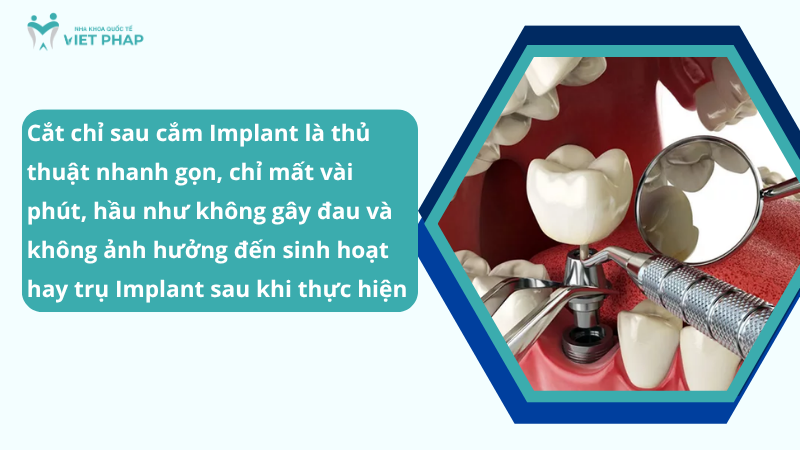Cam implant bao lau cat chi 3 Cắt chỉ sau cắm Implant là thủ thuật nhanh gọn, chỉ mất vài phút, hầu như không gây đau và không ảnh hưởng đến sinh hoạt hay trụ Implant sau khi thực hiện
