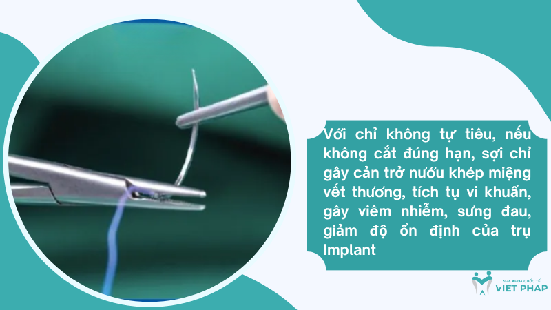 Cam implant bao lau cat chi 5 Với chỉ không tự tiêu, nếu không cắt đúng hạn, sợi chỉ gây cản trở nướu khép miệng vết thương, tích tụ vi khuẩn, gây viêm nhiễm, sưng đau, giảm độ ổn định của trụ Implant